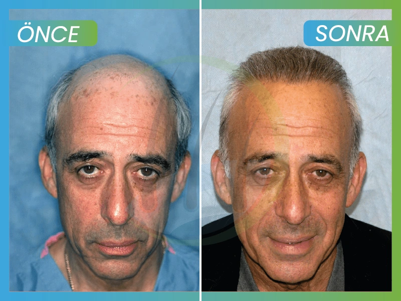 Safir FUE Saç Ekimi before after